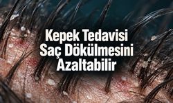 Kepek Tedavisi Saç Dökülmesini Azaltabilir: Ancak Her Dökülme Kepekten Değil