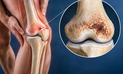 Femur Alt Uç Aseptik Nekrozu Nedir, Nasıl Tedavi Edilir?