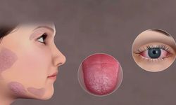 Sjögren hastalığı nedir? Göz ve ağız kuruluğunda dikkat edilmesi gerekenler