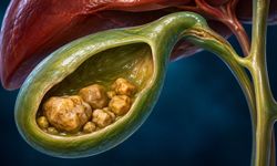 Safra kesesi taşı belirtileri nelerdir, ne zaman ameliyat gerekir?