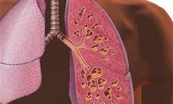 Kistik Fibrozis tedavisinde çığır açan ilaç: Trikafta ile yaşam süresi ve kalite artıyor