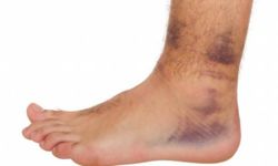 Hemofili tedavisinde yeni dönem: Gen terapisi kanamaları yıllarca durdurabiliyor