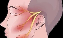 Trigeminal Nevralji, Diş Ağrısı Sanılan “Delirten Hastalık”