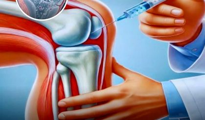 Diz kireçlenmesinde yeni denge: PRP tedavisi kimlerde gerçekten işe yarıyor?