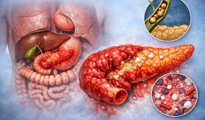 Pankreatit Nedir? Belirtileri, Nedenleri ve Tedavisi