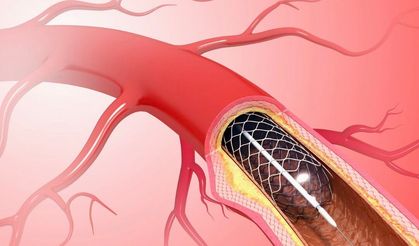 Stentte Nokta Atışı Dönemi: Görüntü Destekli Stent Daha Başarılı