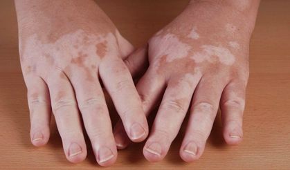 Vitiligo Sadece Cildi Etkilemiyor: Tanıdan Tedaviye Bilinmesi Gerekenler