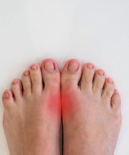 Gut tedavisinde yeni umut: Kalp krizi ve inme riski düşebilir