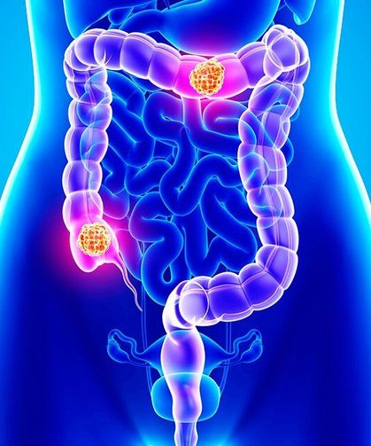 Dışkıda Kan Görürseniz Dikkat! Kolon Kanseri Alarmı