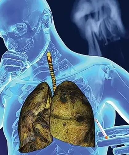 Ağız mikrobiyomu akciğer kanseriyle ilişkilendirildi: Bazı bakteriler öne çıkıyor