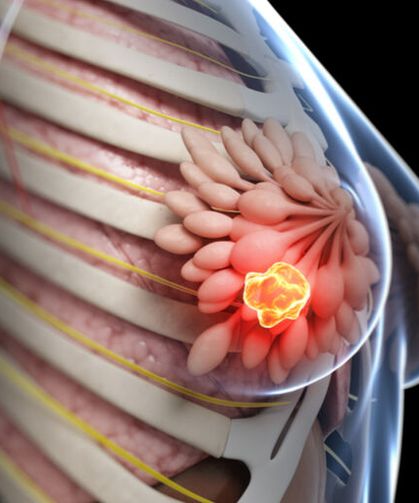 Mucize Diye Sunuluyor Ama… Alternatif Tedavi Meme Kanseri Hastalarını Riske Atıyor