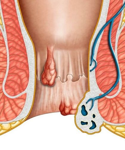 Basur Neden Olur? Hemoroid Belirtileri ve Tedavisi