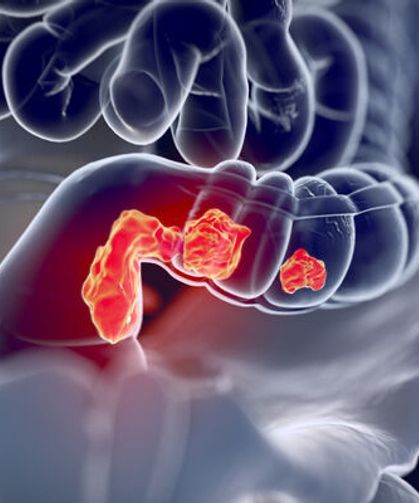 Rektal Kanser Artıyor: Genç Yetişkinlerde Hastalık Yükü Büyüyor