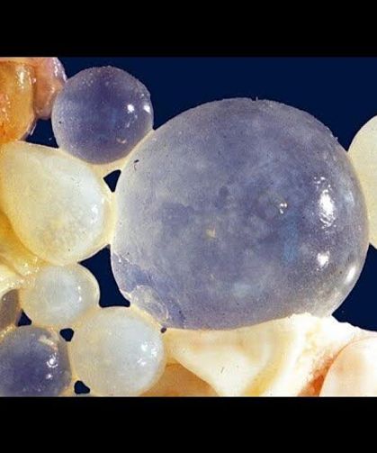 Kist hidatik nasıl bulaşır? Belirtileri, riskleri ve tedavi yolları