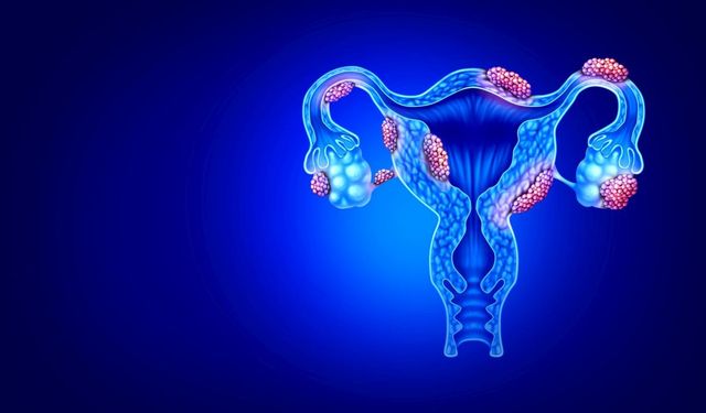 Adenomyozis Nedir? Erken Tanı Yaşam Kalitesini Belirgin Şekilde Artırıyor