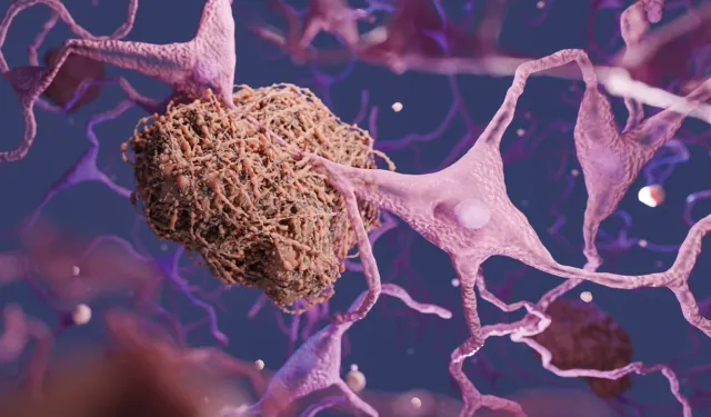 EMA, erken evre Alzheimer’da donanemab tedavisine onay verdi