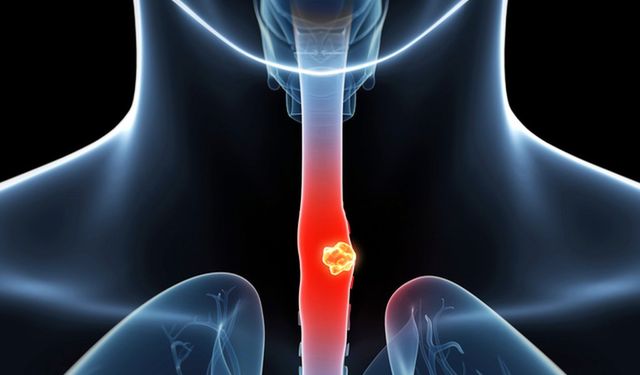 Özofagektomi Nedir? Hangi Hastalarda Uygulanır?