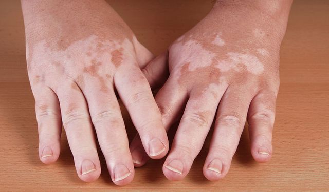 Vitiligo nedir? En güncel tedavi yöntemlerinde yeni dönem
