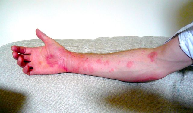 Ürtiker Hakkında Doğru Bilinen Yanlışlar: Uzman Görüşü