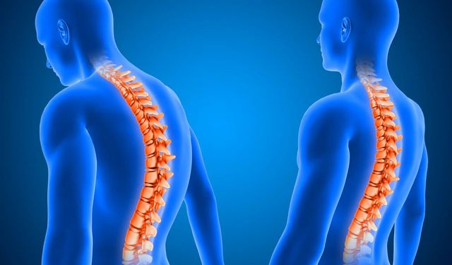 Geçmeyen Bel Ağrısına Dikkat: Ankilozan Spondilit Genç Yaşta Başlayabiliyor