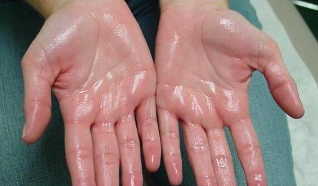 “Terlemek kaderim” demeyin: Aşırı terleme için tıbbi tedavi mümkün