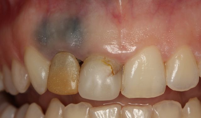 Ağız Kanserinde Uyarı: Diş Etindeki Pigmentli Lekeler Göz Ardı Edilmemeli