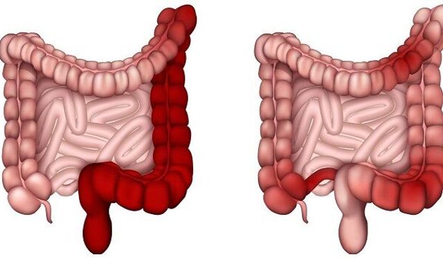 Dışkıda kan görmek ne anlama geliyor? Uzmanlar uyarıyor: küçük belirti, büyük mesaj olabilir