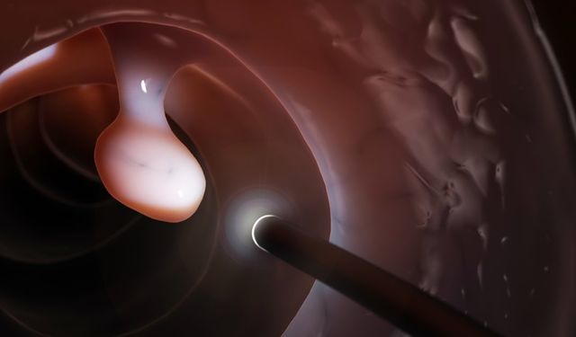 Kurkumin ve Quercetin Tabanlı Kombinasyon Polip Yükünü Belirgin Azalttı