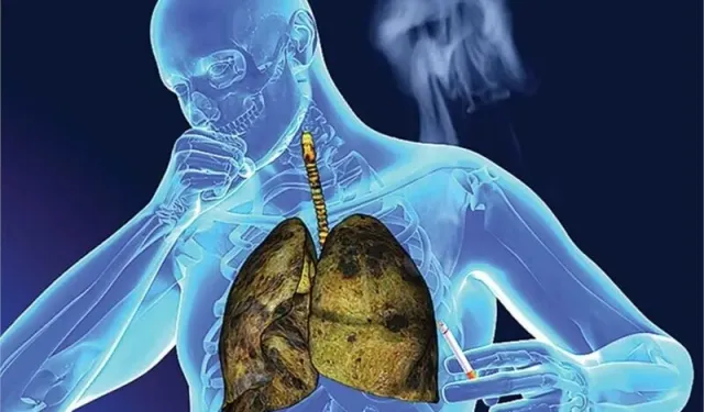 Ağız mikrobiyomu akciğer kanseriyle ilişkilendirildi: Bazı bakteriler öne çıkıyor