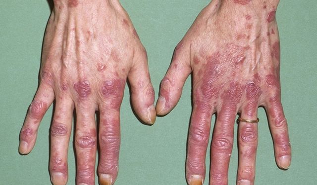 Lupus nedir? Genç kadınlarda daha sık görülüyor; erken tanı hayatı değiştiriyor
