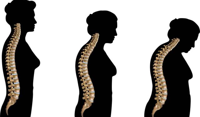 Kırık Olana Kadar Fark Edilmiyor: Osteoporoz Sessizce Nasıl İlerliyor?