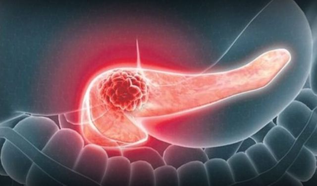 Pankreas kanseri sinir hücrelerini ‘yeniden programlıyor’: Tümör büyümesi hızlanabiliyor