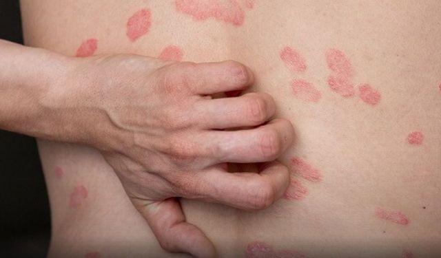 Ciltte Tek Bir Leke ile Başlıyor: “Herald Patch” Nedir?