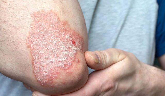 Sedefle Sınırlı Değil: Psoriatik Artrit Eklem Hasarına Yol Açabiliyor