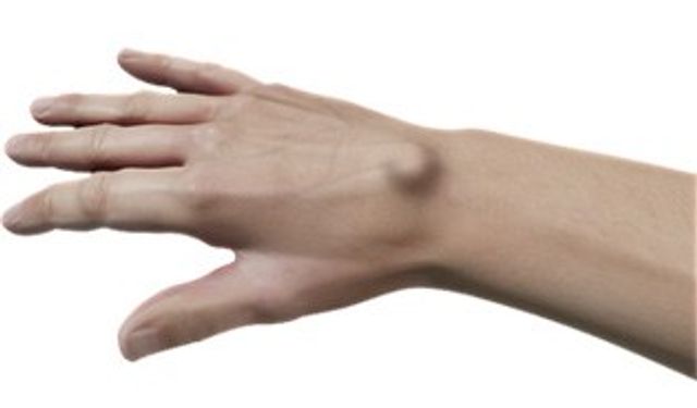 Kistler Neden Ortaya Çıkar, Ne Zaman Müdahale Gerekir?