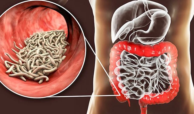 Belirti Vermeden Organlara Zarar Veren Parazit Solucanlar