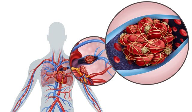 Kolon Kanserinde Sessiz Tehlike: Pulmoner Emboli Riski