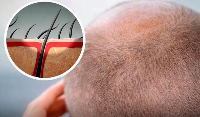 Kellik Tarih mi Oluyor? Şeker İçerikli Jel Saç Büyümesini Tetikledi