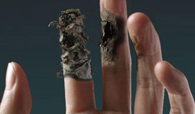 Buerger Hastalığı Belirtileri, Teşhisi ve Güncel Tedavileri