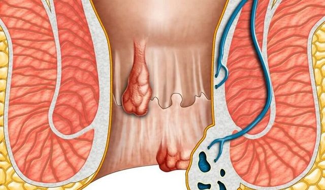 Basur Neden Olur? Hemoroid Belirtileri ve Tedavisi