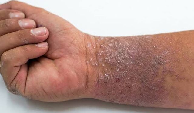 Egzama Belirtileri ve En Etkili Tedavi Yolları