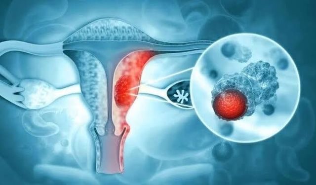 Endometriozis Belirtileri Nelerdir? Şiddetli Adet Sancısı Normal mi?
