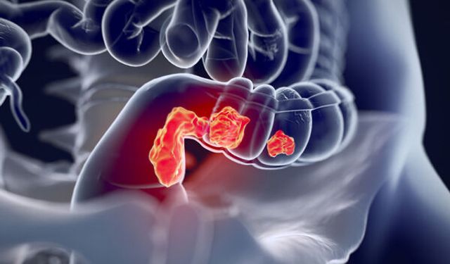 Rektal Kanser Artıyor: Genç Yetişkinlerde Hastalık Yükü Büyüyor