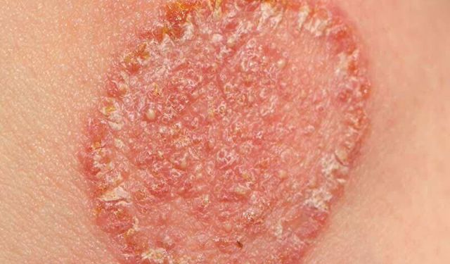 Sıcak Hava ve Terleme Fungal Enfeksiyonları Artırıyor: Uzmanlardan Uyarı