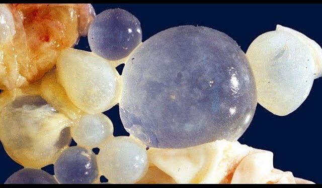 Kist hidatik nasıl bulaşır? Belirtileri, riskleri ve tedavi yolları