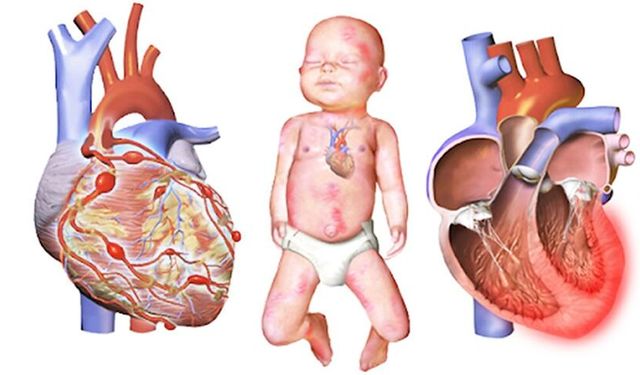 Kawasaki Hastalığı Nasıl Anlaşılır? Çocuklarda Erken Belirti ve Tedavi Uyarısı