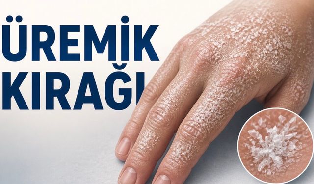 Üremik Kırağı (Uremic Frost) Nedir? Ciltte Görülen Bu Beyaz Tabaka Ne Anlama Gelir?