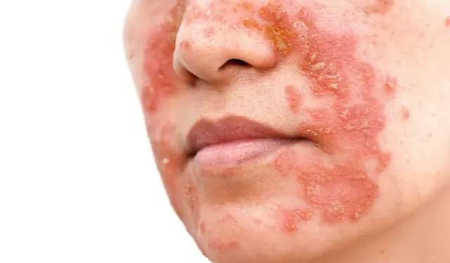 Seboreik Dermatit: Belirtileri, Nedenleri ve Güncel Tedavi Seçenekleri