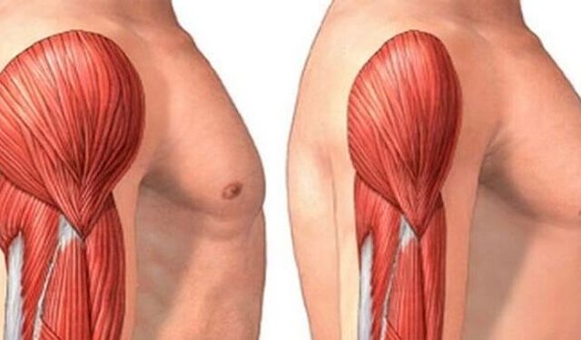 Sarkopeni Belirtileri, Nedenleri ve Tedavisi: Yaşa Bağlı Kas Kaybı