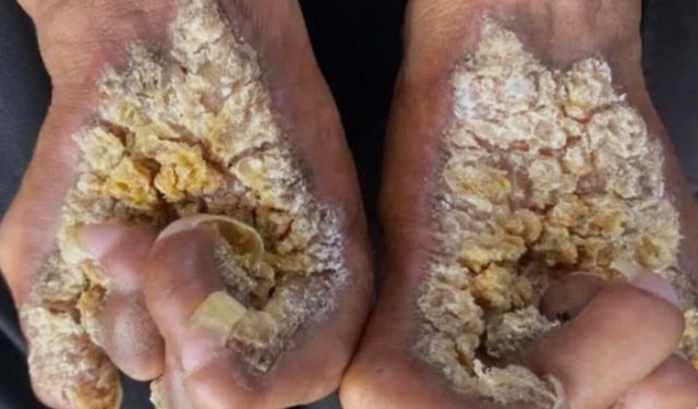 Siğil Sanılabiliyor: Epidermodysplasia Verruciformis Nedir?